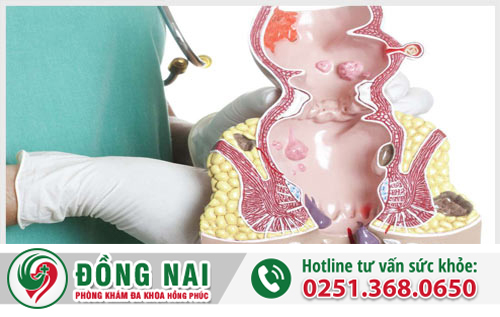 Bệnh hậu môn gồm những bệnh gì?