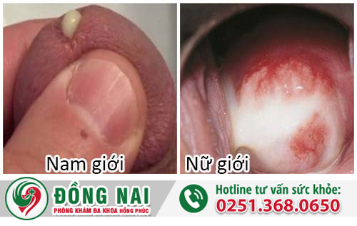 bênh tình dục