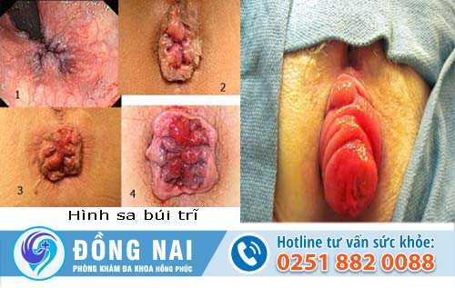 Bệnh sa hậu môn trực tràng là gì và cách chữa trị tốt nhất