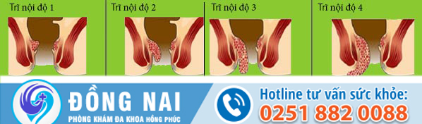 Bệnh trĩ và các cấp độ nguy hiểm