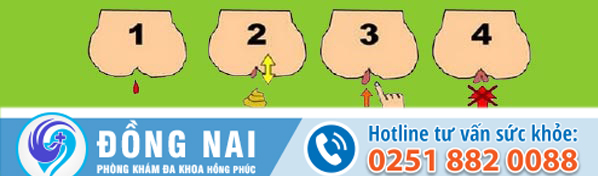 Bệnh trĩ và các cấp độ nguy hiểm