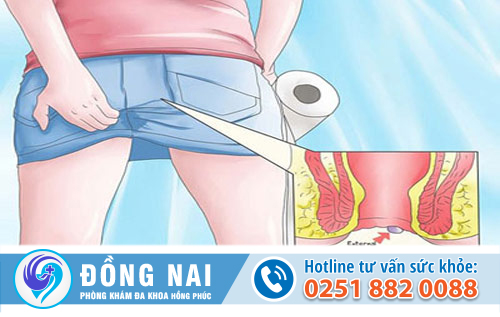 Trĩ ngoại có phải là một căn bệnh nguy hiểm?