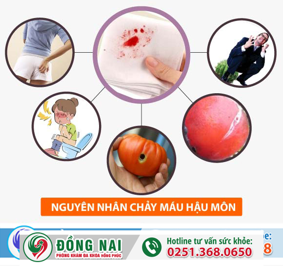 Chảy máu hậu môn là dấu hiệu bị gì?
