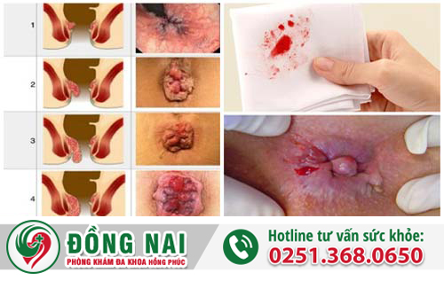 Trĩ hỗn hợp gây chảy máu, sa búi trĩ, đau rát, ngứa ngáy, khó chịu ở vùng hậu môn