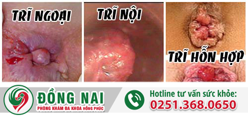 Phân biệt trĩ nội, trĩ ngoại, trĩ hỗn hợp
