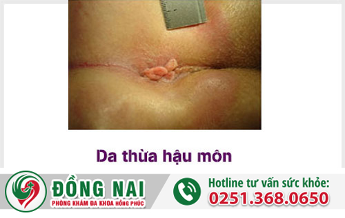 Da thừa hậu môn có tự lành không?