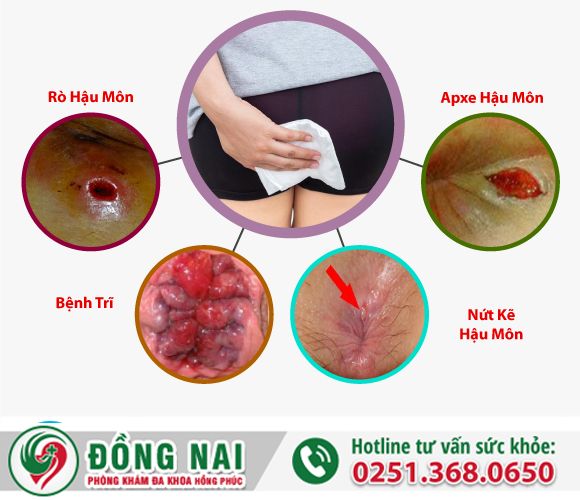 Hiện tượng đi vệ sinh ra máu tươi là bệnh gì?