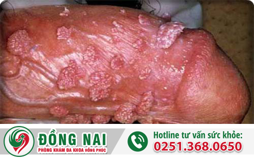 Dấu hiệu dương vật nổi mụn là gì?