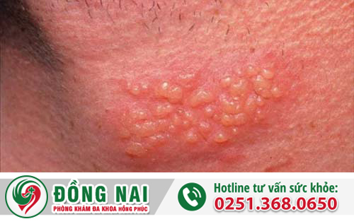  dấu hiệu dương vật nổi mụn là gì?