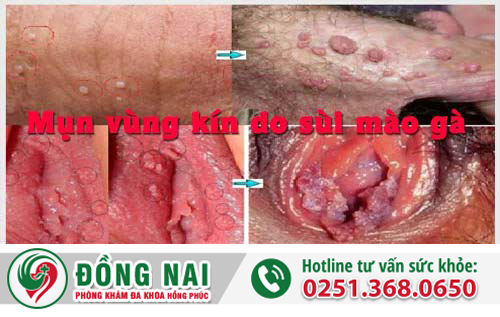 Dấu hiệu mụn vùng kín có thể là bệnh gì?