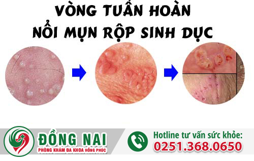 Dấu hiệu mụn vùng kín có thể là bệnh gì?