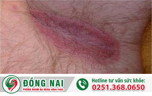 Dấu hiệu nhận biết bệnh chàm hậu môn là gì?