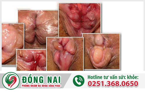 Bệnh trĩ mãn tính là gì và cách điều trị?