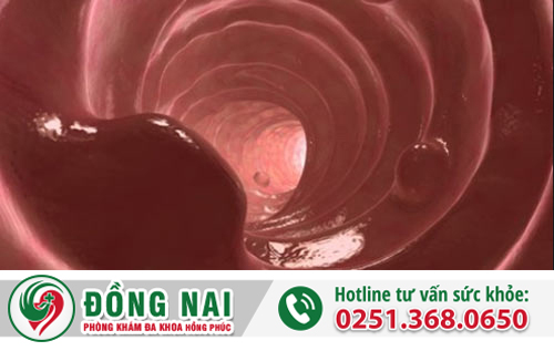 Polyp hậu môn