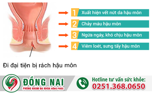 Đi đại tiện bị rách hậu môn là bị như thế nào?