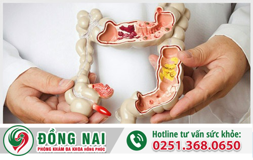 Đi ỉa ra máu là bệnh gì?