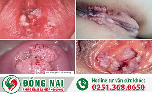 Hình ảnh sùi mào gà giai đoạn đầu ở nữ giới