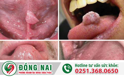 Cách phát hiện sùi mào gà sớm nhất