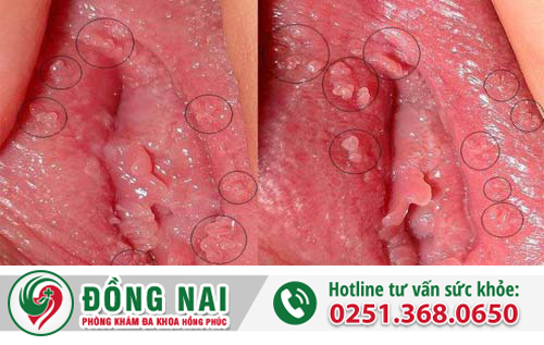 Mọc mụn thịt ở môi lớn có phải là sùi mào gà?