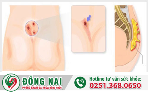 Hình ảnh rò hậu môn