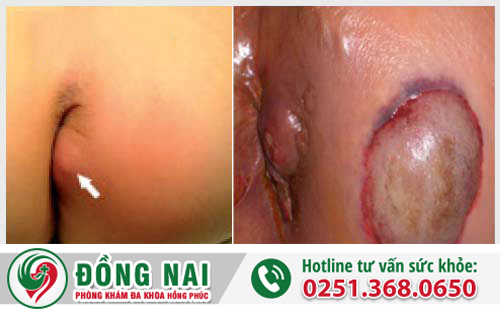 mụn nhọt hậu môn