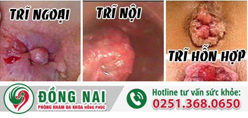 Nguyên nhân đi cầu ra máu