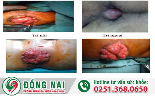 Nguyên nhân gây bệnh sa búi trĩ và cách chữa trị