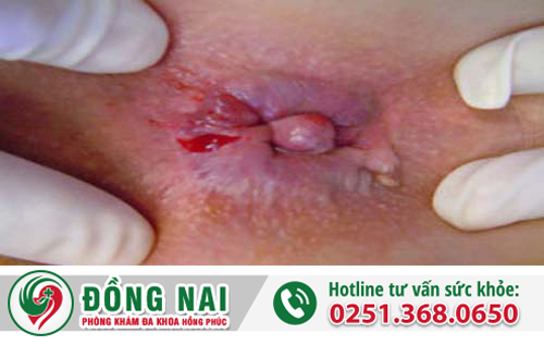 Nổi cục u hậu môn - Những biến chứng nguy hiểm và phương pháp hỗ trợ điều trị hiệu quả