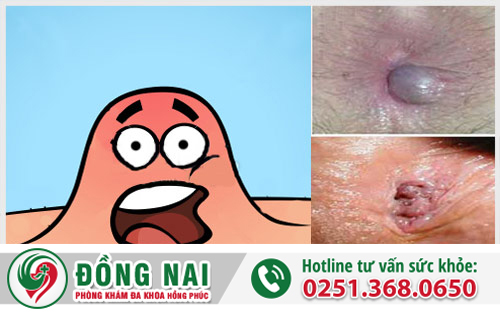 Nổi mụn nhọt ở hậu môn là bệnh gì?