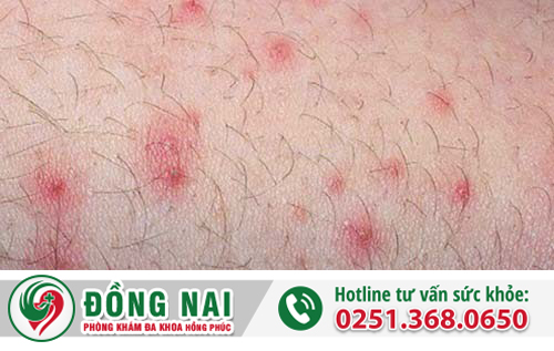 Nổi mụn ở âm đạo của nữ giới