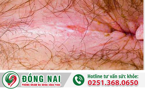 Bệnh viêm nhiễm hậu môn là gì?