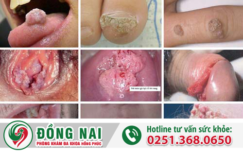 đôi nét về bệnh sùi mào gà