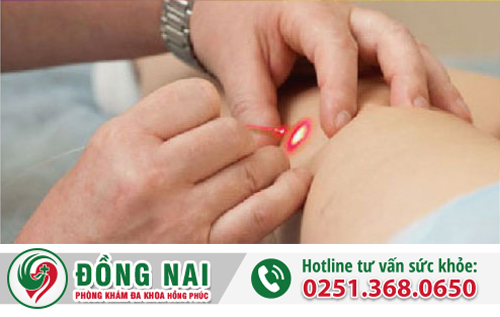 Đốt laser là chiếu trực tiếp tia lên vùng da nổi sùi mào gà