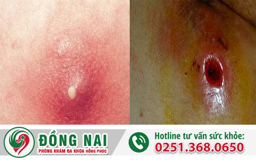 Phương pháp điều trị và cách chữa mụn nhọt hậu môn đạt hiệu quả