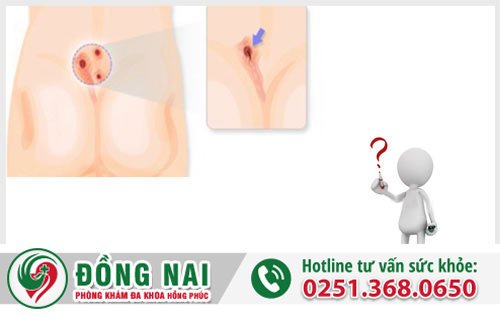Rò hậu môn có thể tự điều trị tại nhà được không?