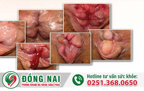 Sa búi trĩ là bệnh gì – Dấu hiệu, nguyên nhân, điều trị ra sao?