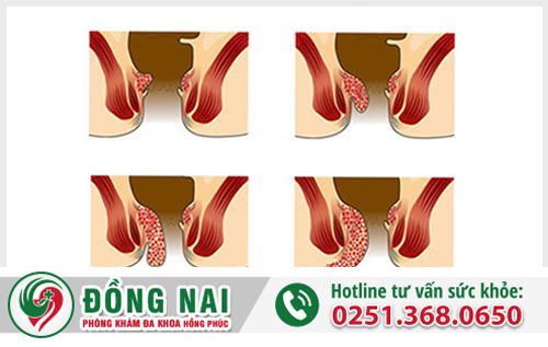Diễn tiến tình trạng sa búi trĩ (lòi dom, lòi trĩ)