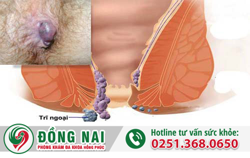Tất tần tật về bệnh trĩ tắc mạch