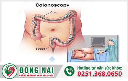 Thế nào là nội soi trĩ?
