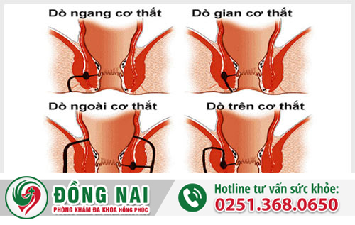 Rò hậu môn và hình ảnh thực tế