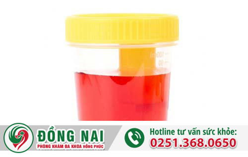Hiện tượng tiểu ra máu sau khi quan hệ
