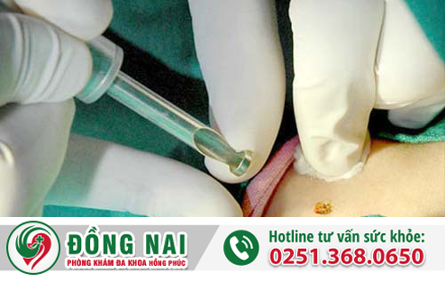 Đốt sùi mào gà có đau không?