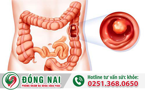 Tìm hiểu về bệnh Polyp hậu môn
