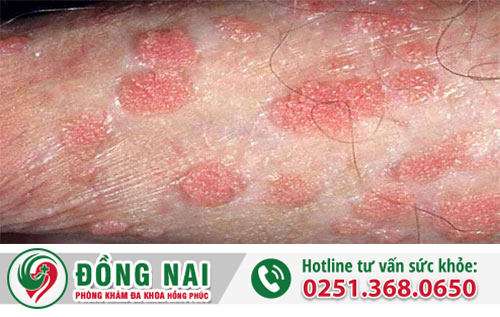 Tình trạng dương vật nổi hạt ở nam giới