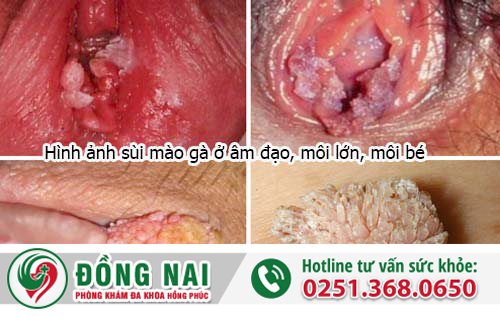 hình ảnh bệnh xã hội sùi mào gà nữ