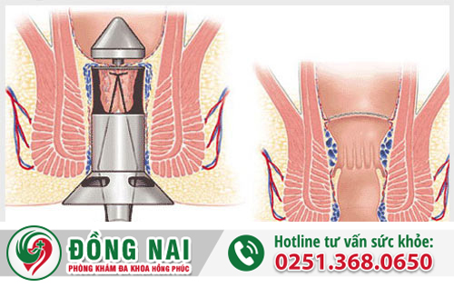 Điều trị trĩ nội bằng phương pháp HCPT