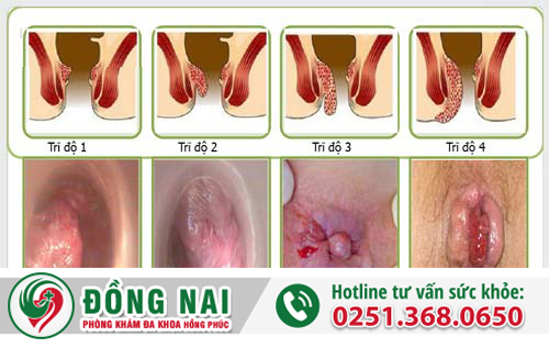 Trĩ nội hình thành bên trong đường ống hậu môn