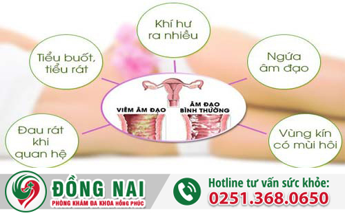 Triệu chứng cho thấy nữ giới đang bị nấm vùng kín và cách điều trị hiệu quả