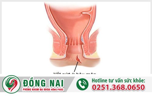 Vì sao bị nứt kẽ hậu môn